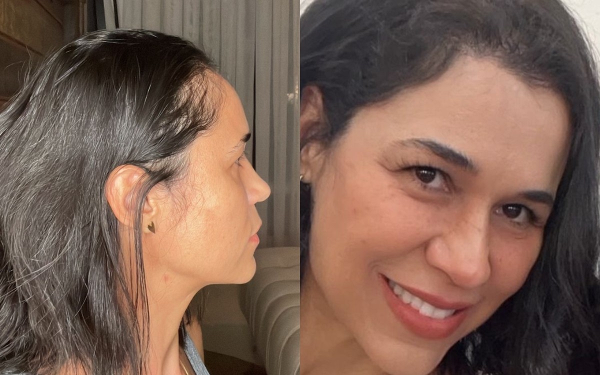 Alopecia e autoestima: transplante capilar é alternativa para homens e mulheres