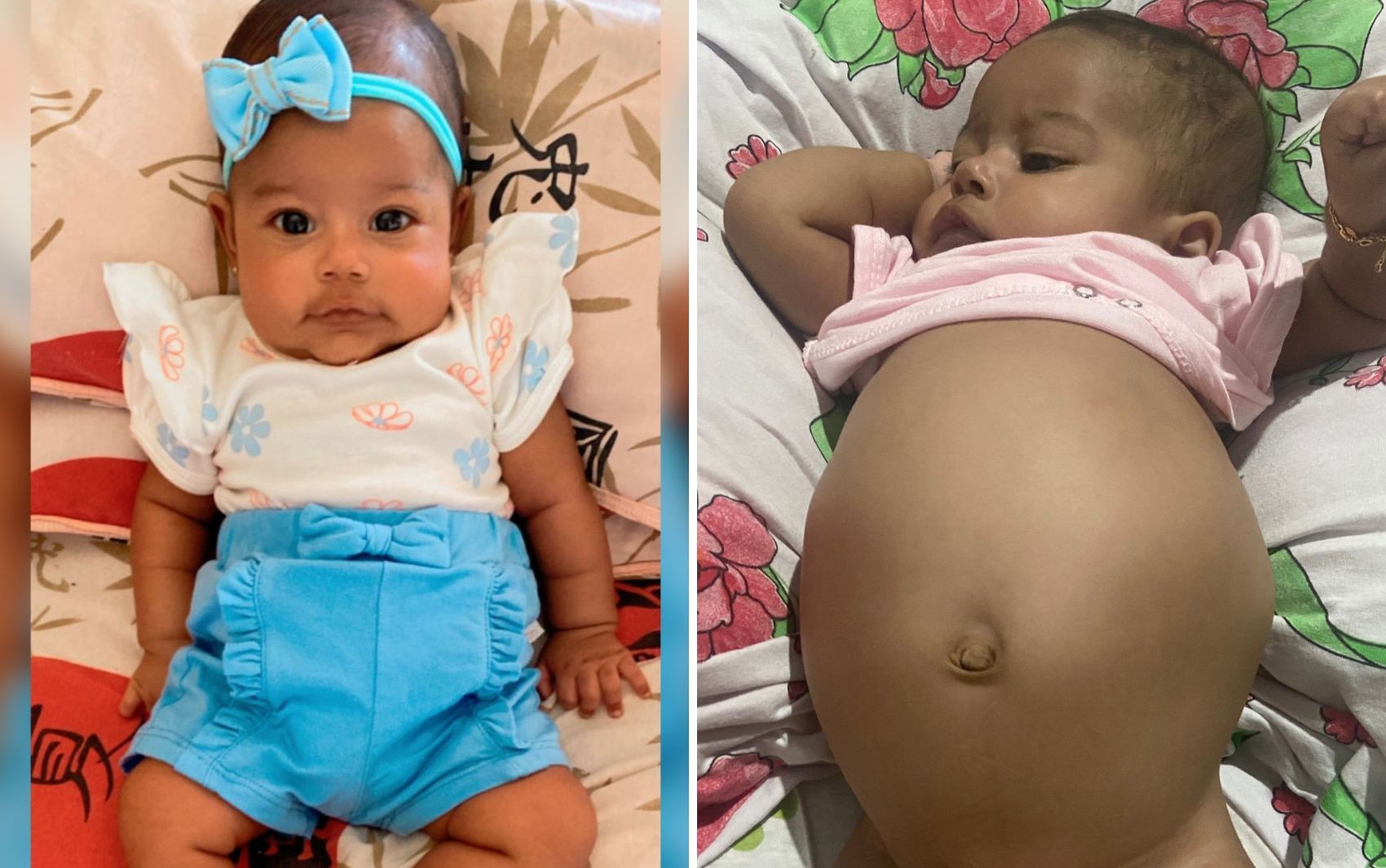 Bebê goiana de 4 meses com suspeita de tumor na barriga luta por tratamento na rede pública