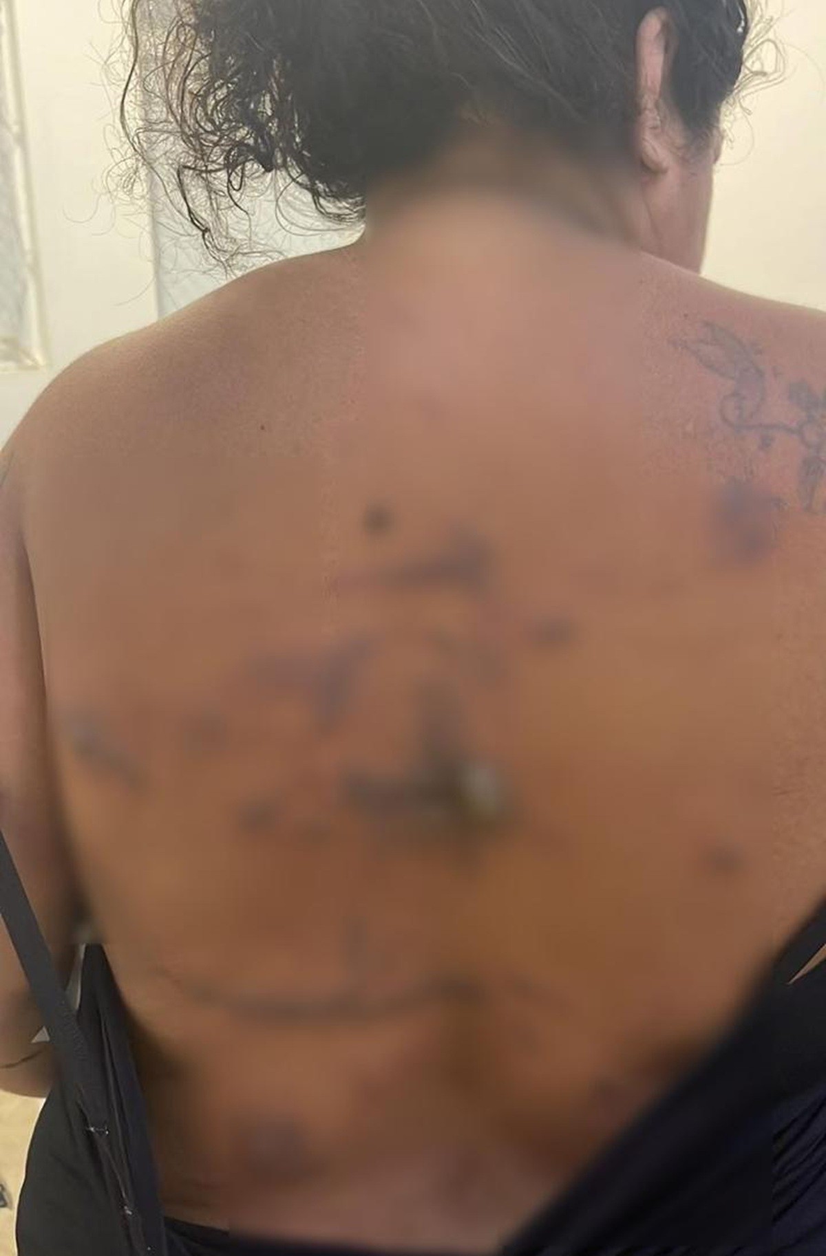 Paciente denuncia queimaduras durante cesariana realizada em hospital de Arraial do Cabo