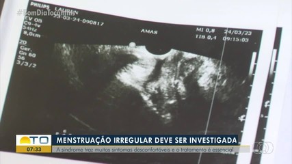 Dores e menstruarão irregular podem ser sintomas da síndrome do ovário policístico