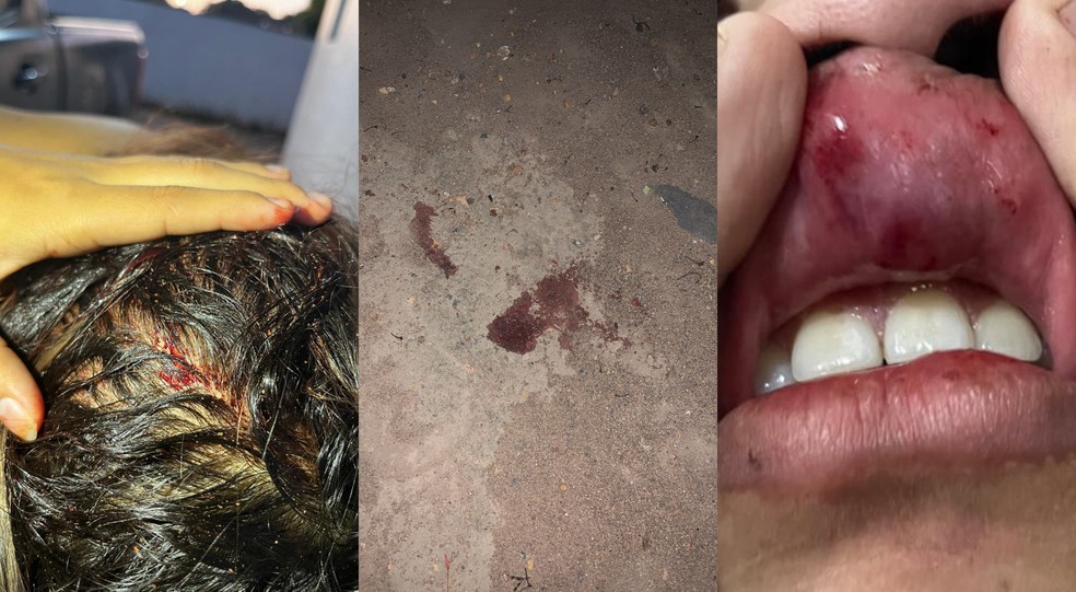 Vítima apresentava série de hematomas após agressões do companheiro — Foto: Reprodução