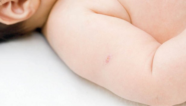Mais de 75% dos bebês receberam a vacina BCG em seis meses no Acre