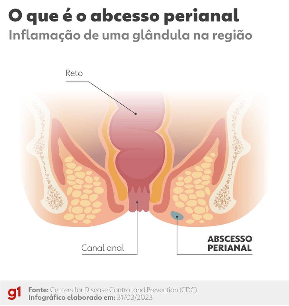 O que é o abscesso perianal — Foto: g1