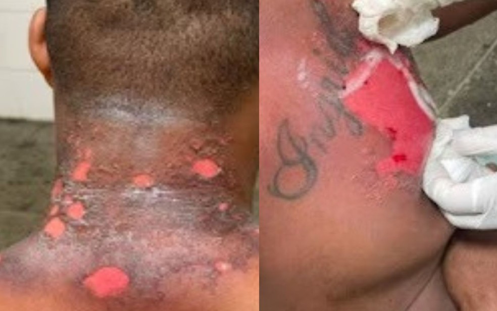 PM sofre queimaduras no pescoço e no peito após ser atingido por substância química no oeste da Bahia — Foto: Reprodução/Redes Sociais