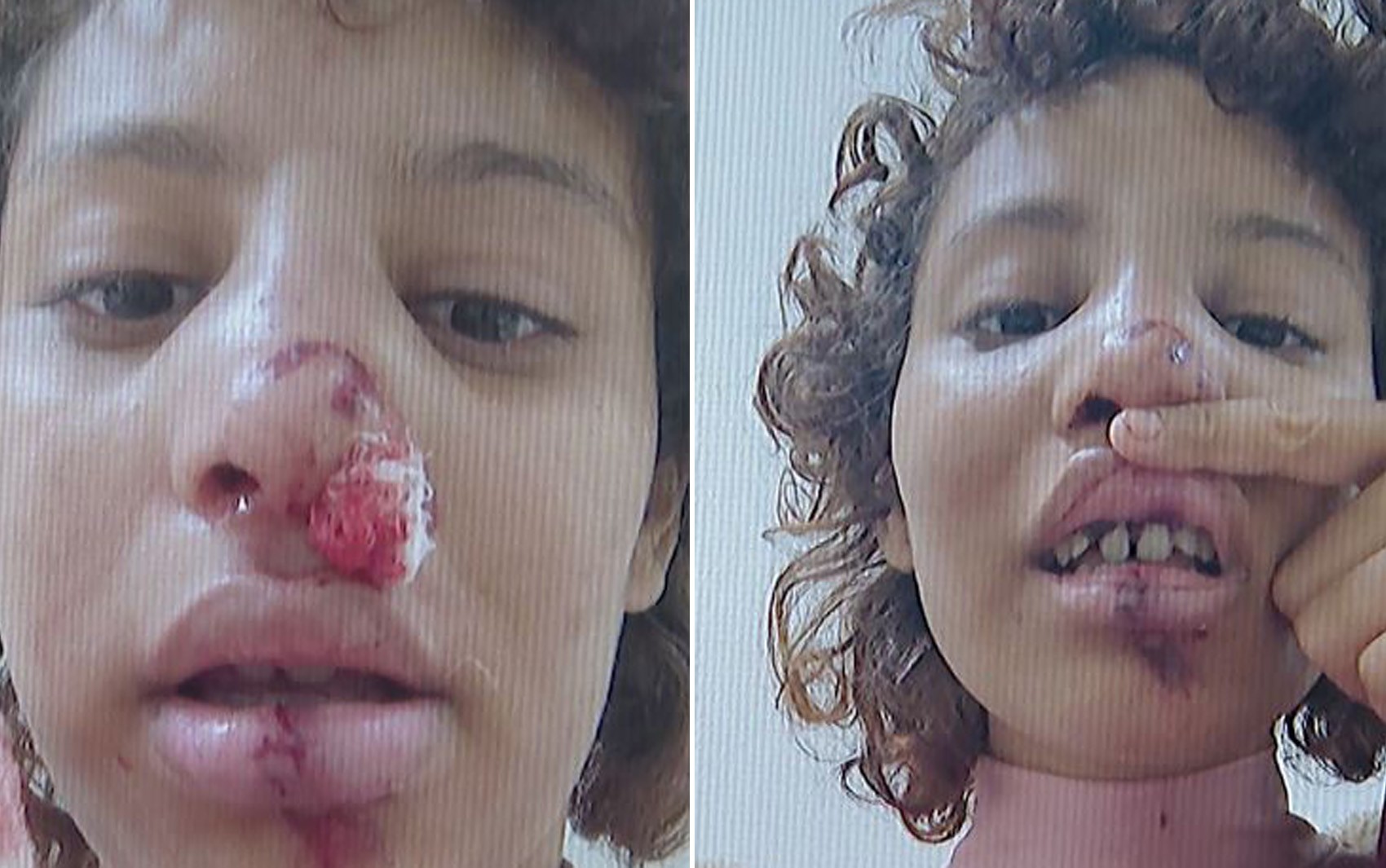 'Desumano', diz estudante que ficou desfigurada ao ser atropelada por motorista que fugiu em Sertãozinho, SP