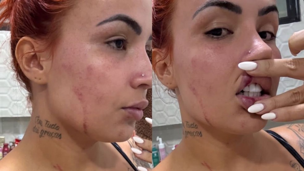 Ao acusar ex-marido, influenciadora divulgou fotos e vdeos de agresses  Foto: Reproduo/Instagram (@aruivinhaoficiall)