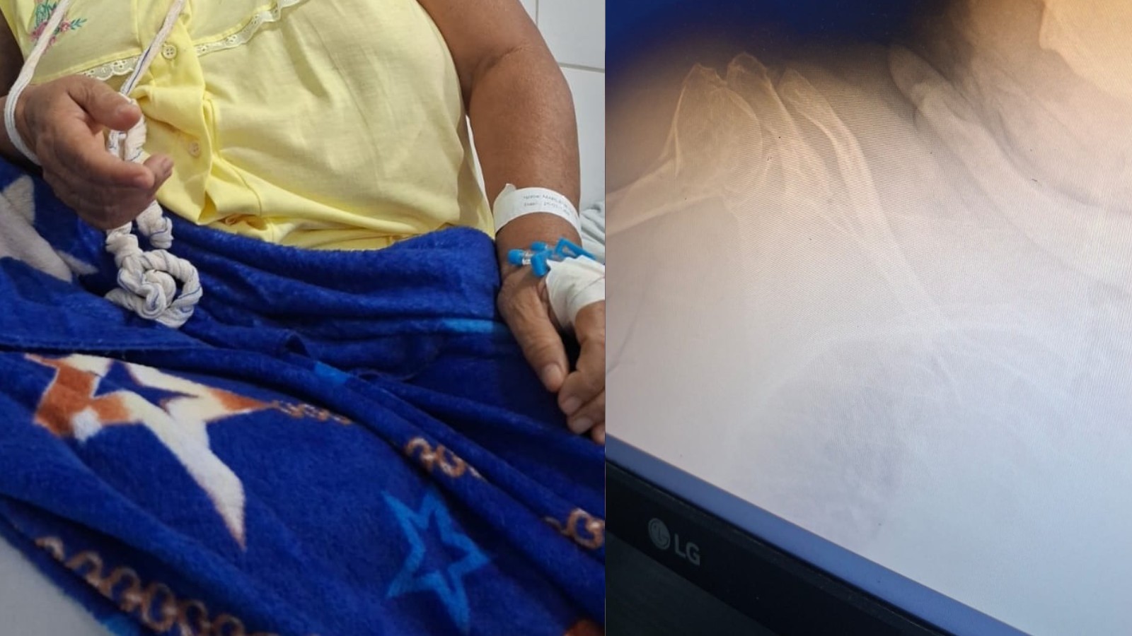 Mulher de 66 anos espera há 8 dias por vaga para cirurgia após fraturar braço em Teresina: 'muita dor'