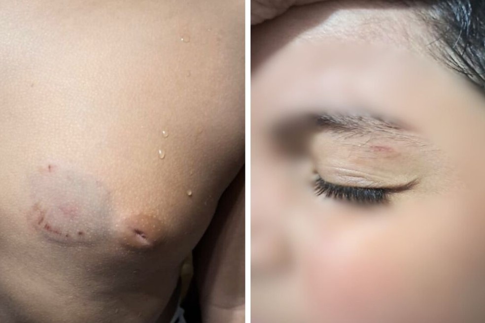 Menino de sete anos ficou com cicatriz no peito e com um machucado no olho após ser agredido em escola de Santos, SP — Foto: Arquivo pessoal