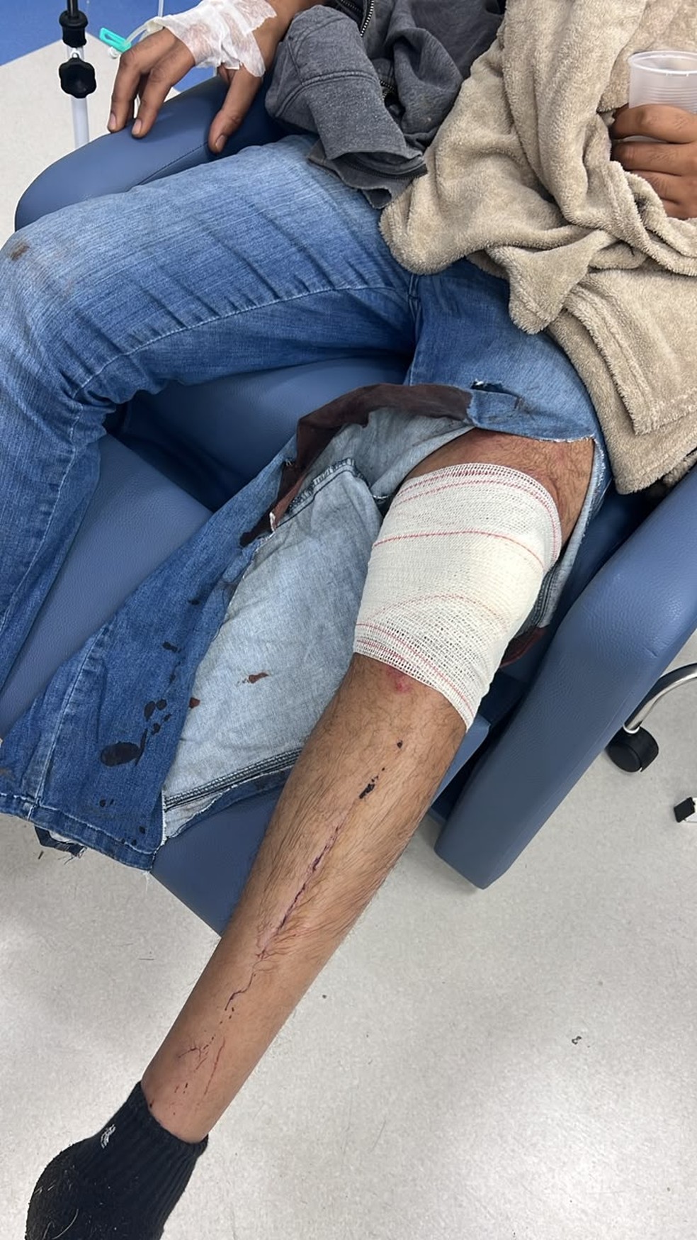 Noivo da vítima quebrou a costela e fraturou uma das pernas — Foto: Arquivo pessoal