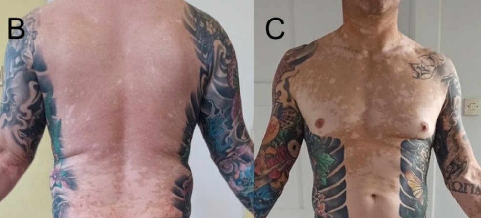 Homem desenvolveu vitiligo após tatuagem — Foto: Divulgação