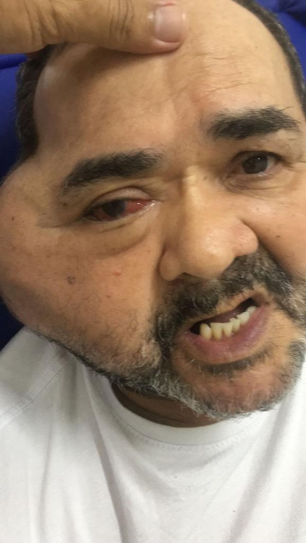 José Nilton Cardozo tem um tumor no rosto — Foto: Divulgação