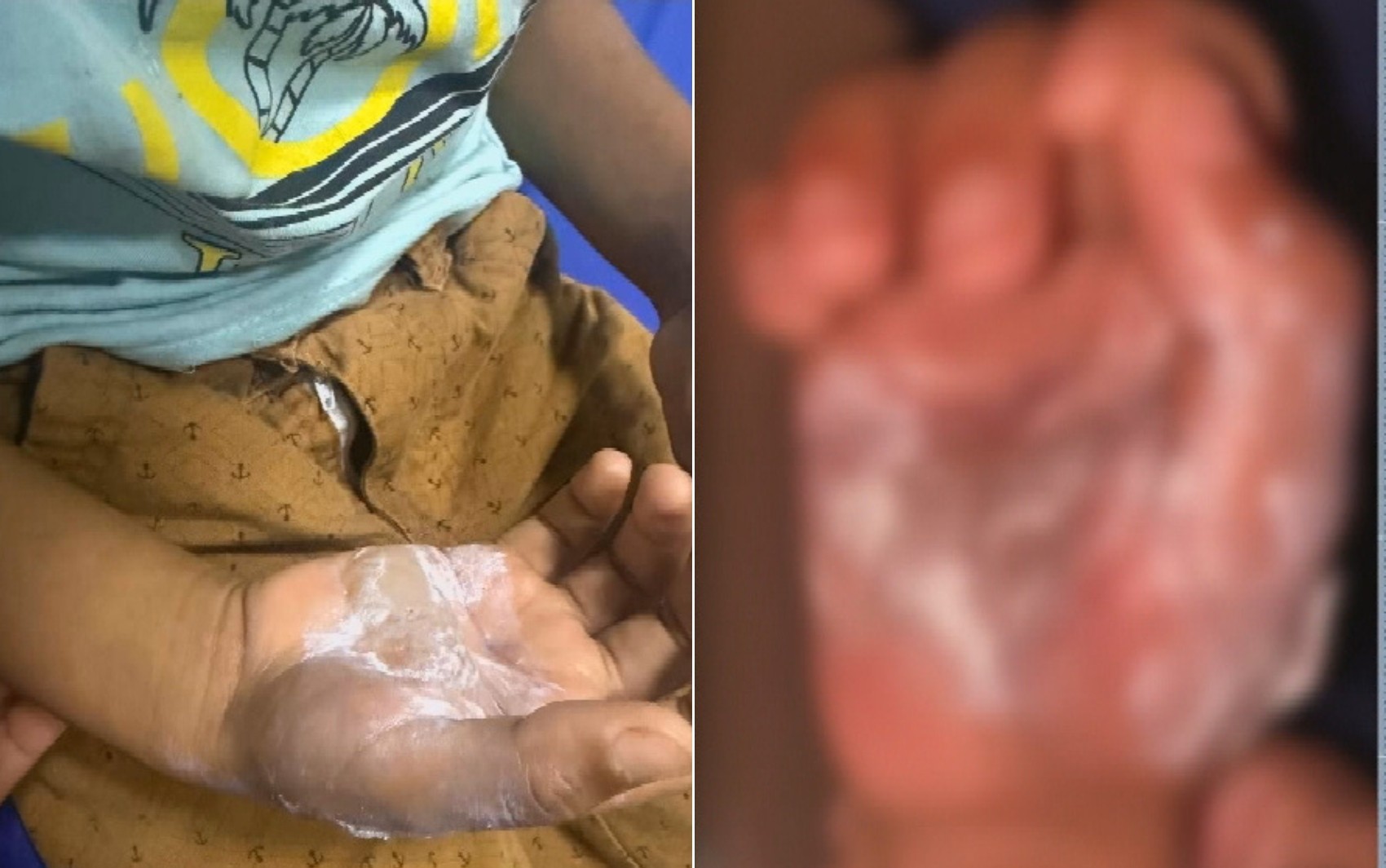 Mãe é presa por queimar filho com colher quente em Goiás | g1 | G1