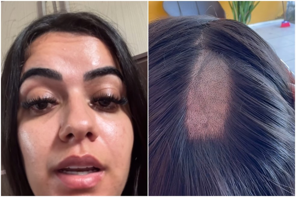 Mulher denuncia falha em exame toxicológico para CNH após ter parte da cabeça raspada em laboratório na PB — Foto: Reprodução
