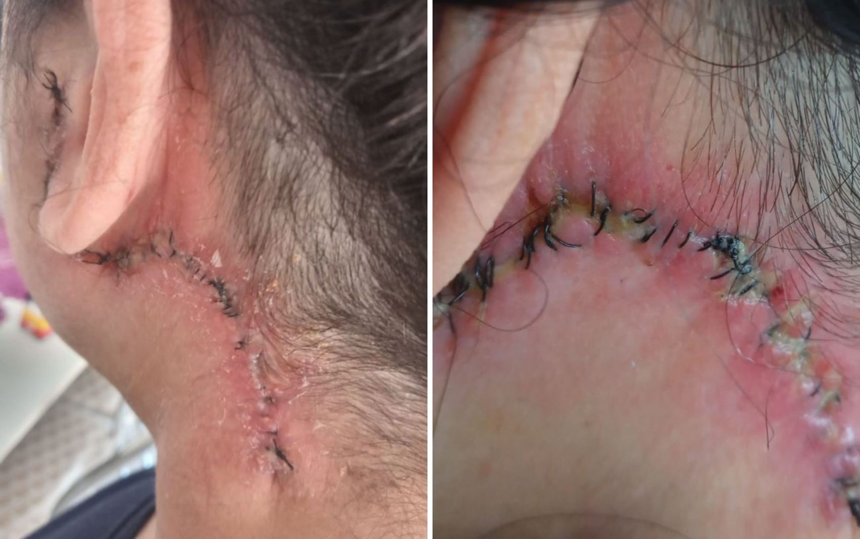 Pescoço inchado, sangramento, rosto paralisado: veja relatos de mulheres que denunciaram dentista após complicações em procedimentos estéticos