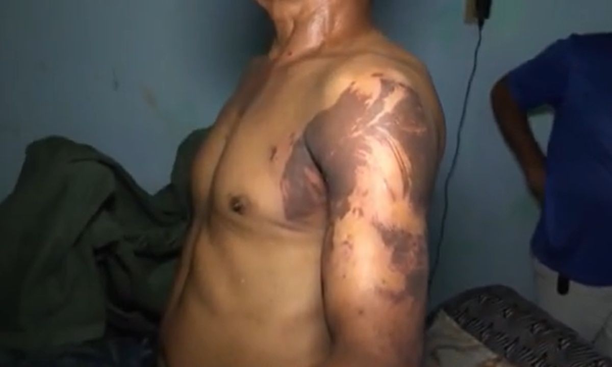 Homem é preso por atacar três pessoas da mesma família com líquido similar a ácido na Bahia