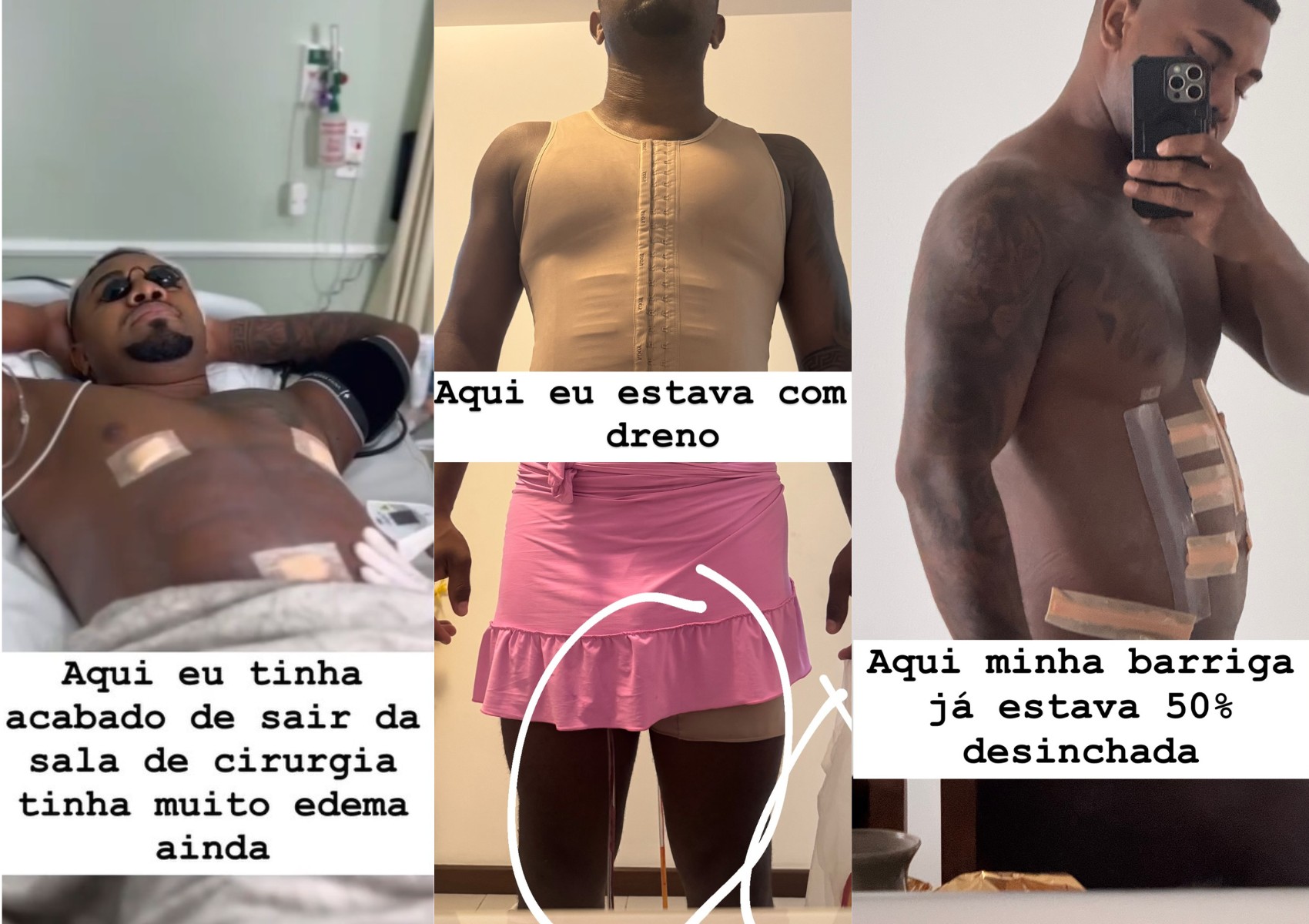 Davi Brito exibe abdômen nas redes após se submeter a lipo HD