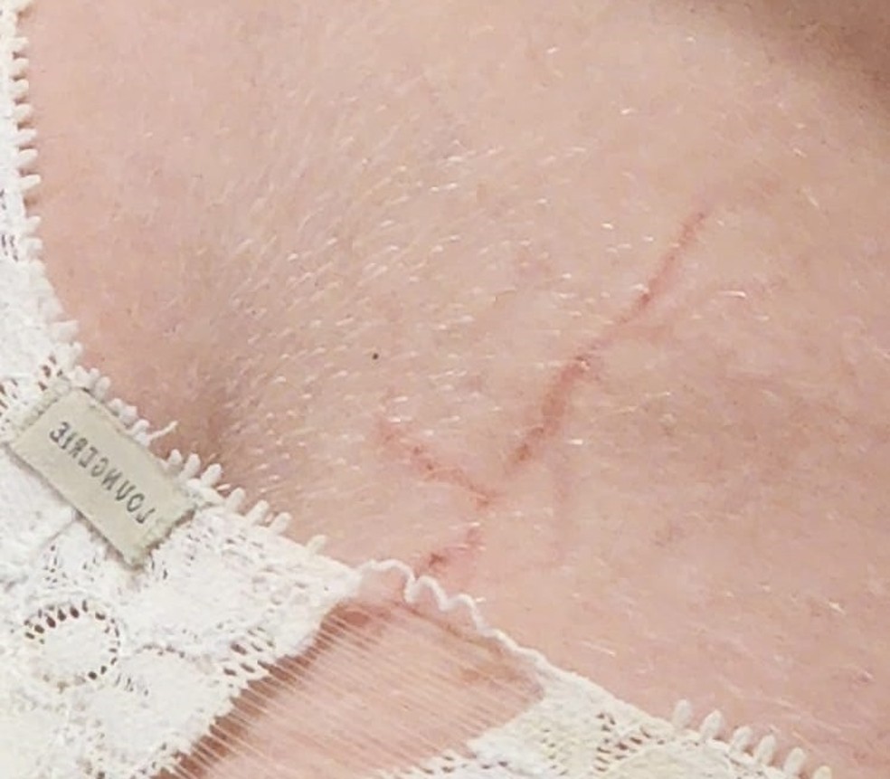 Grávida é atingida por raio e fica com marca no corpo — Foto: Rafaela Parra/Arquivo Pessoal