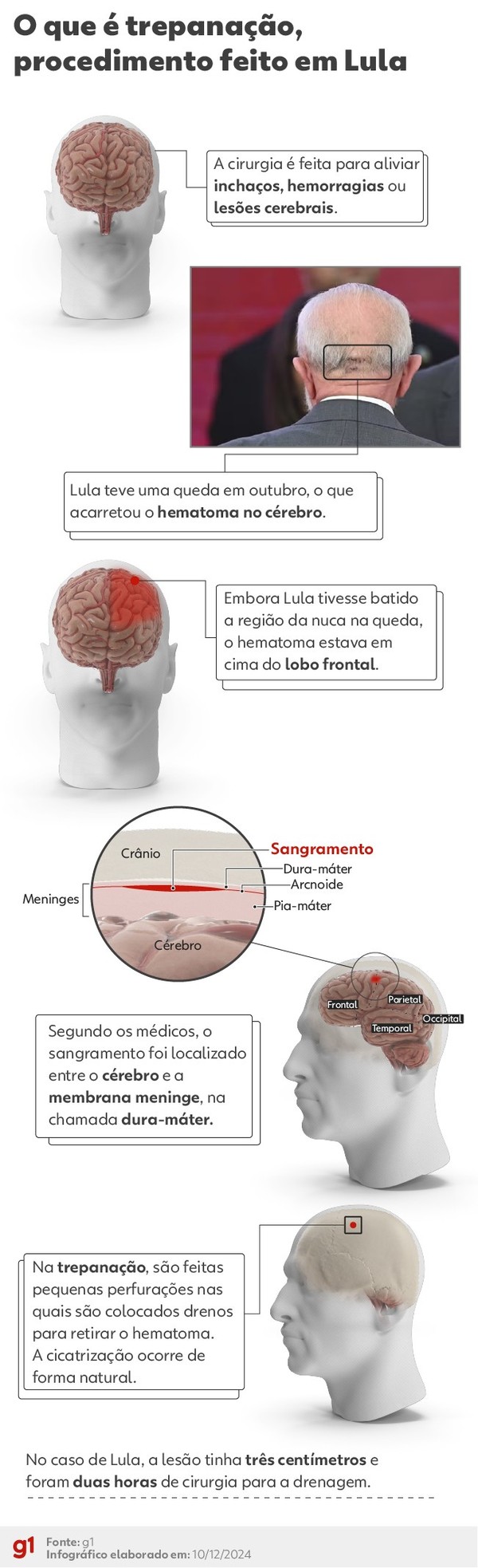 Entenda procedimento feito em Lula após hematoma cerebral — Foto: Arte/g1