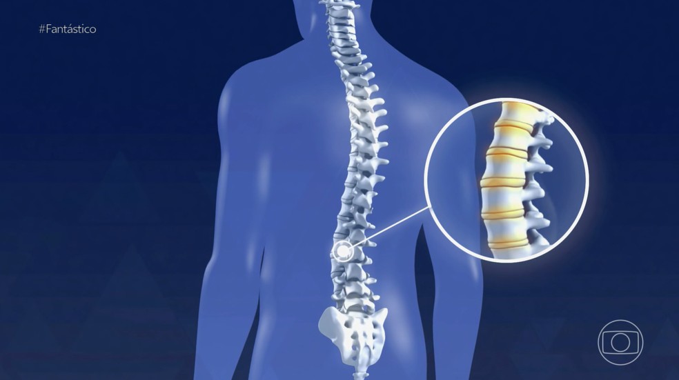 Hérnia de disco foi a doença que mais gerou afastamento do trabalho em 2023 — Foto: Reprodução/Fantástico