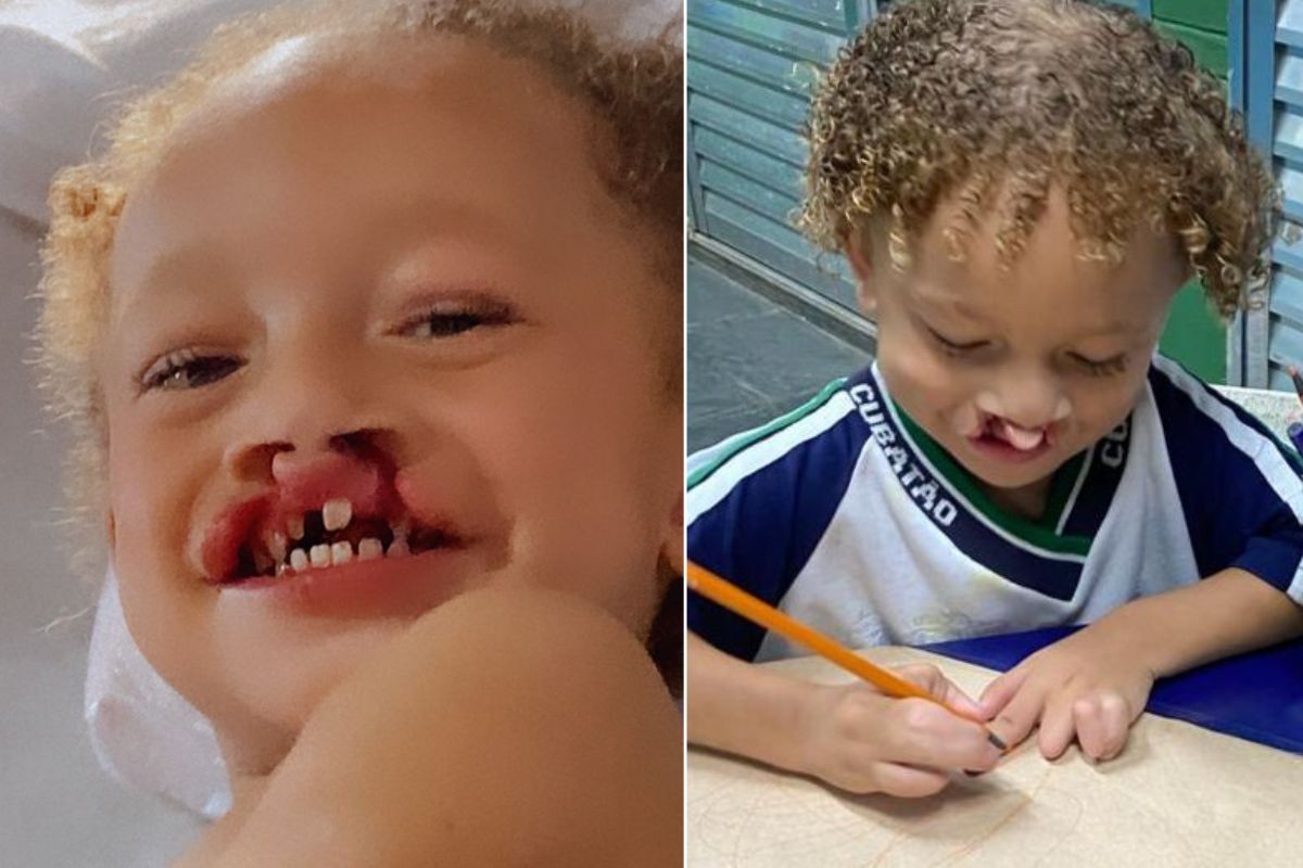 Família de menino com síndrome rara que causou malformações luta por cirurgia nos lábios 