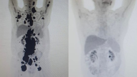 Anvisa autoriza pesquisa clínica com Car-T Cell no Brasil; paciente teve remissão completa de câncer  - Foto: (Arquivo pessoal)