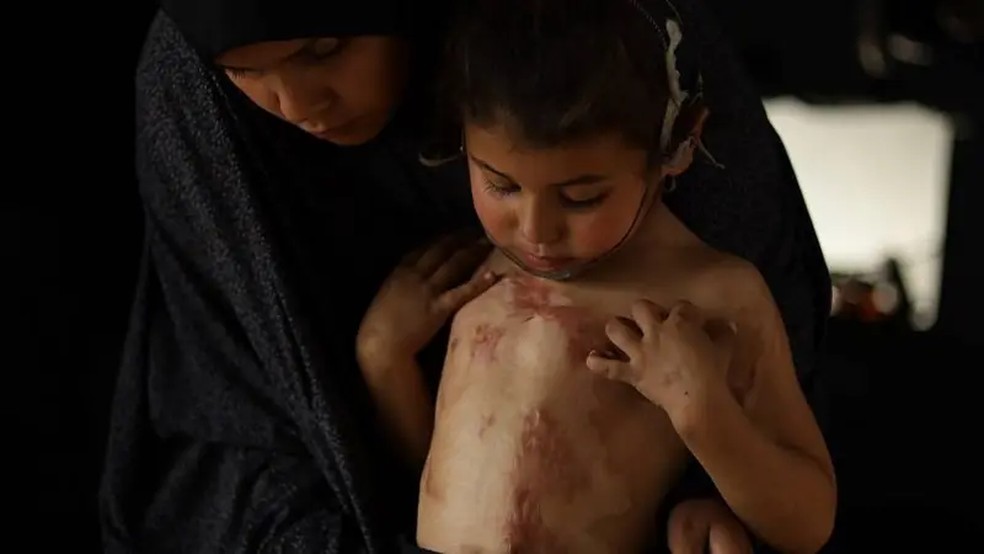 'Quando uma bomba explode, produz uma enorme onda de calor... A principal faixa etária que tratamos por queimaduras é a de crianças de 4 a 6 anos', diz Brubakk — Foto: Getty Images via BBC