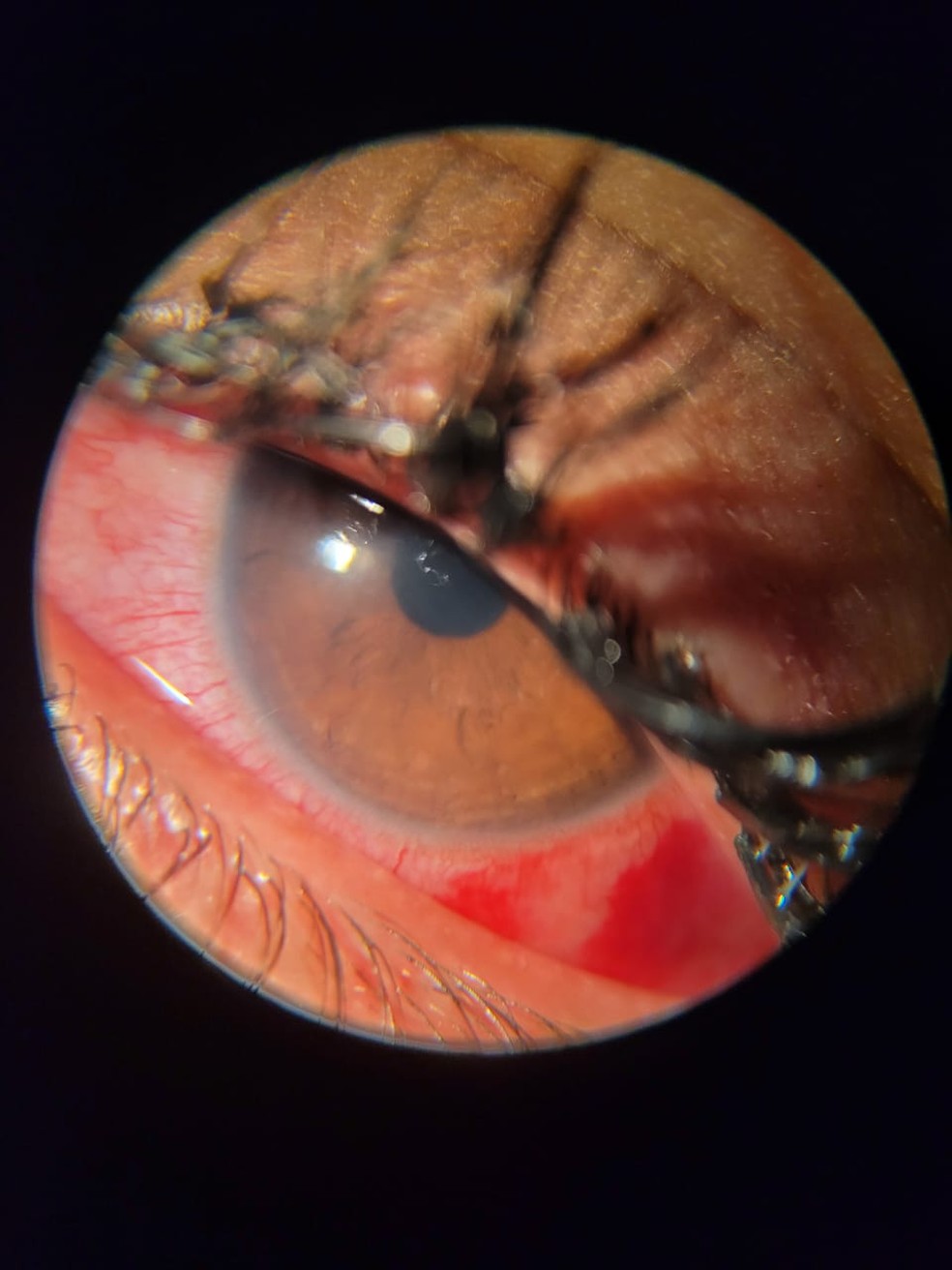 Inflamação nas córneas ocorreu após pomada cair nos olhos durante as prévias — Foto: Fundação Altino Ventura/Divulgação