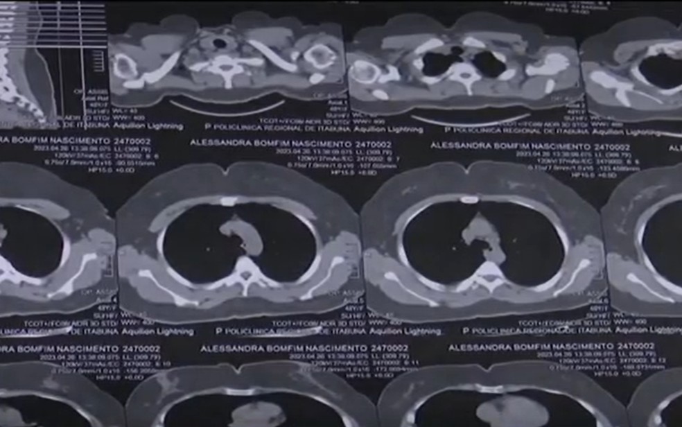 Tomografia realizada em Alessandra que constatou o câncer no pulmão  — Foto: TV Santa Cruz