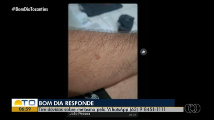 Médica orienta como manter uma rotina de cuidados para controlar o melasma