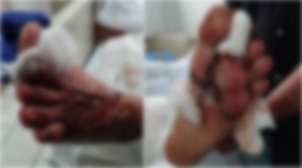 Policial militar passou por uma cirurgia no pé após pisar em bomba caseira clandestina durante um treinamento em Fortaleza. — Foto: Arquivo pessoal