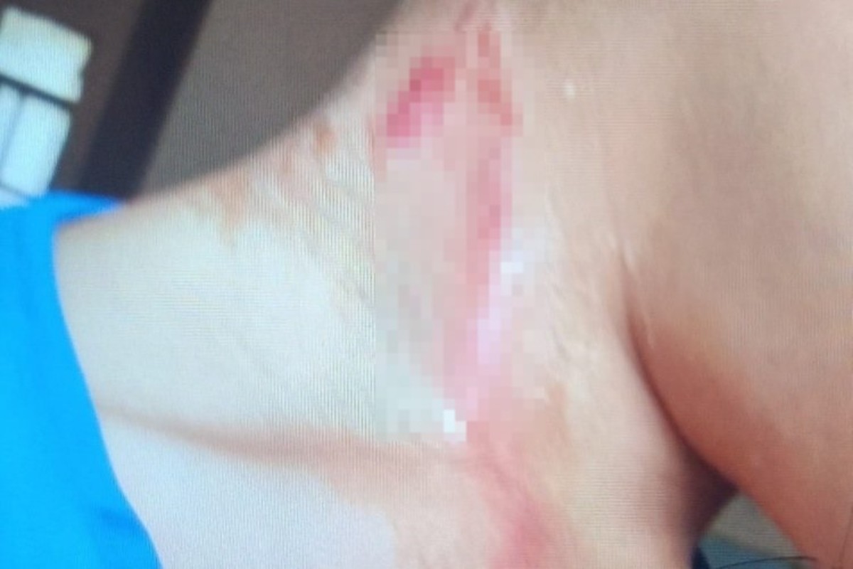 Polícia investiga caso de criança agredida a varadas pelo pai; suspeito impedia menino de ir à escola para que ferimentos não fossem vistos