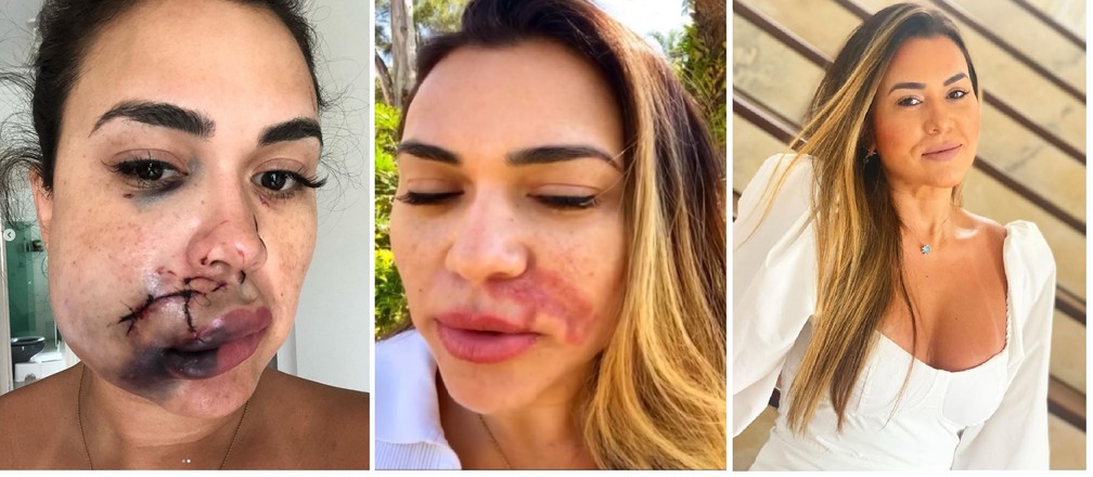 Etapas da recuperação de Milka Borges, três anos depois da agressão sofrida dentro do restaurante Iulia. — Foto: Reprodução/Instagram