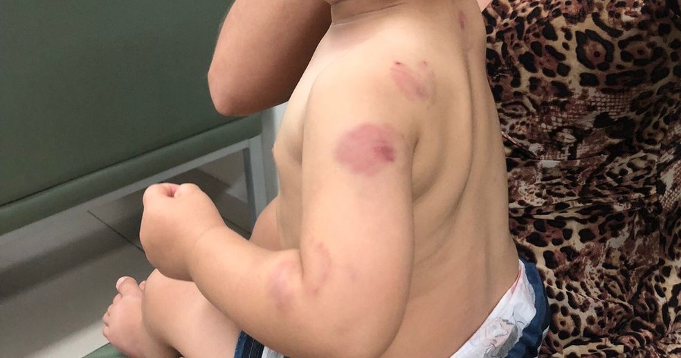 Bebê leva nove mordidas em creche de São Carlos — Foto: Arquivo pessoal