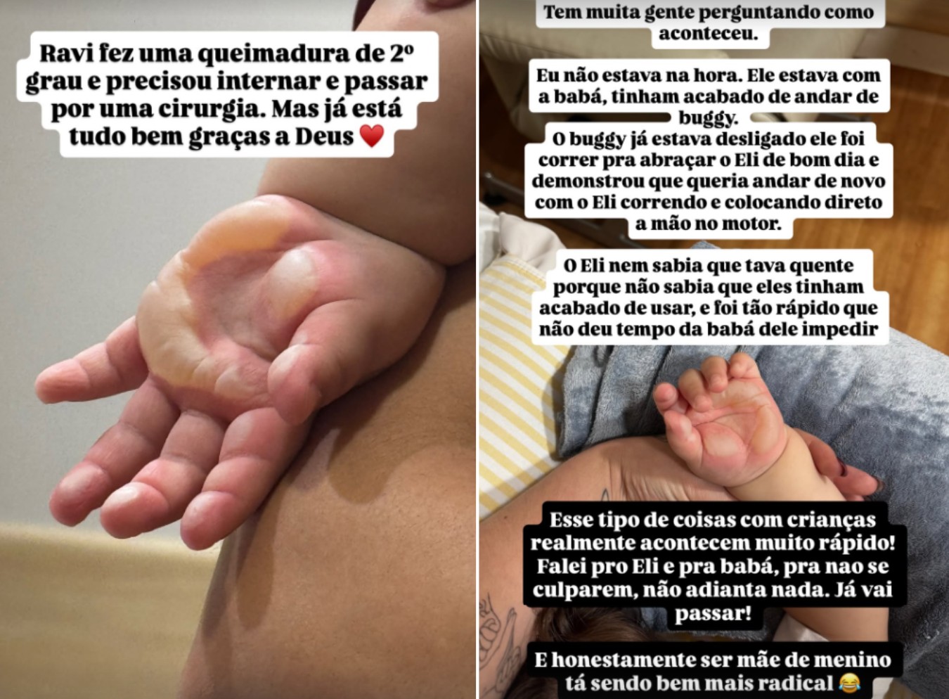 Filho de Viih Tube e Eliezer sofre queimadura na mão e passa por cirurgia