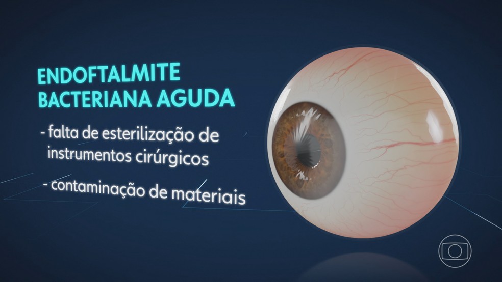 Endoftalmite é uma inflamação aguda no globo ocular causada por uma bactéria — Foto: Jornal Nacional/ Reprodução