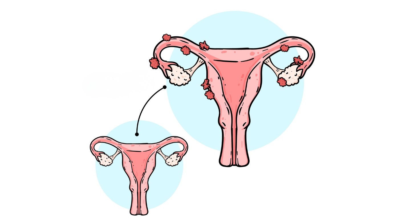 Quais sinais revelam quando a endometriose atinge mais de um órgão?