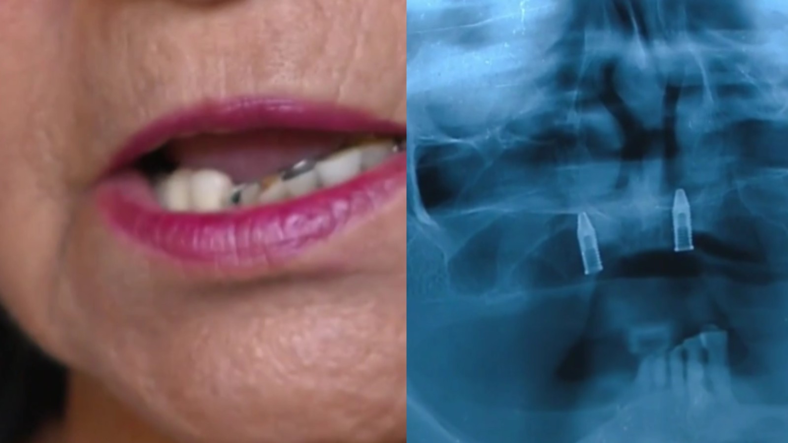 'Não posso ficar sem dentes', diz paciente que teve atendimento bucal suspenso no Piauí 