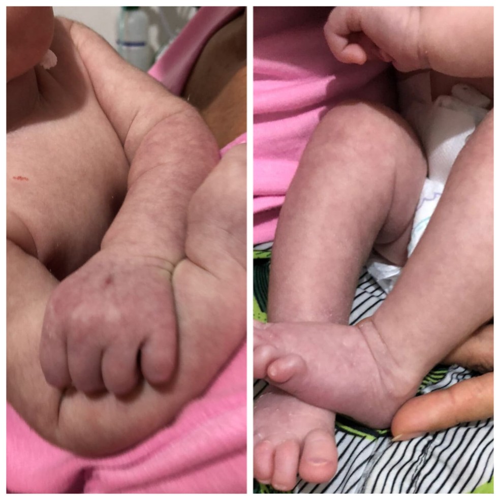 Manchas vermelhas em corpo de bebê de 22 anos que morreu de dengue em AL — Foto: Arquivo pessoal