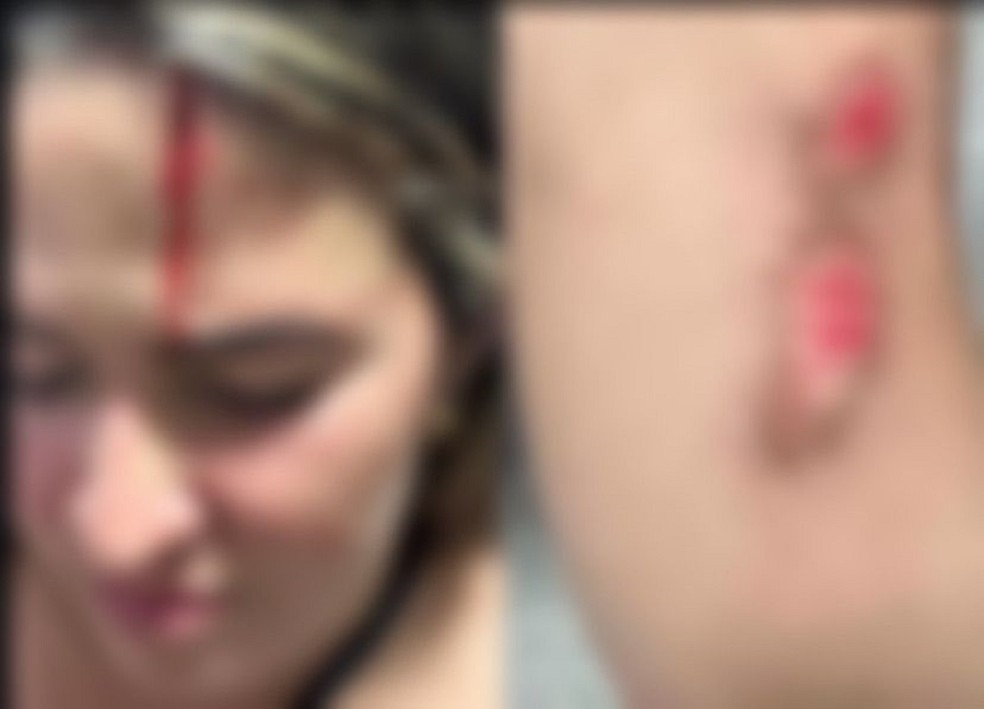 Mulher ferida após ser agredida e atropelada pelo ex, em Olivença. — Foto: Arquivo pessoal