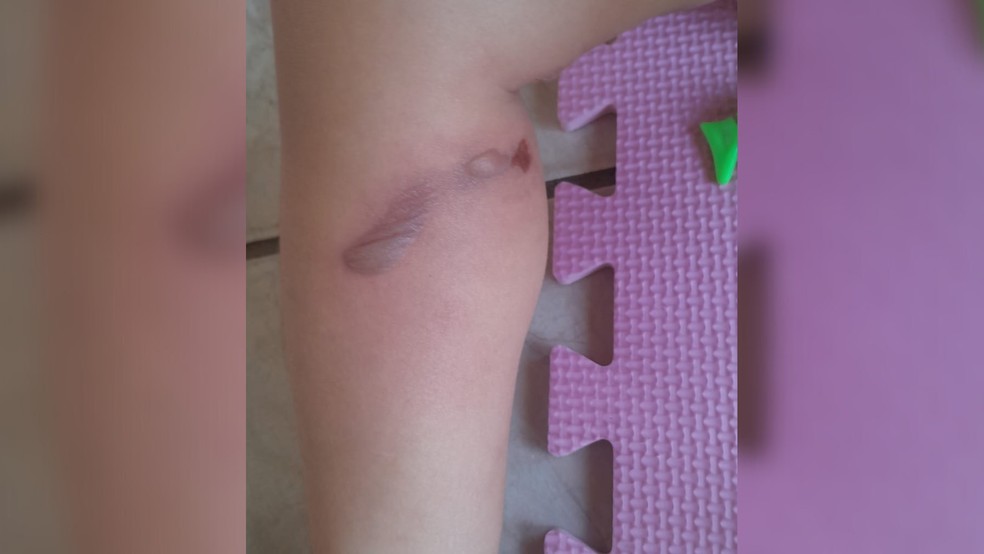 Polícia investiga queimaduras em perna de bebê durante banho em creche em Votuporanga (SP) — Foto: Arquivo pessoal