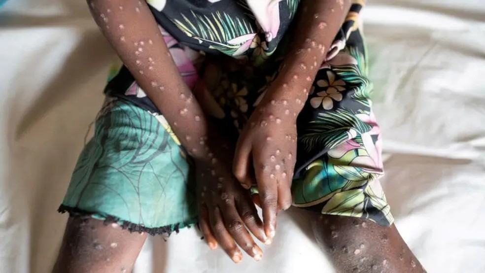 Presidente Prudente (SP) contabiliza nove casos de mpox neste ano — Foto: Reuters