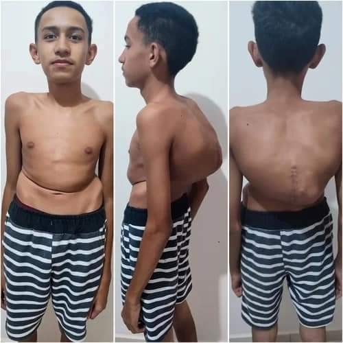 Família de menino com coluna que ultrapassa 100 graus de curvatura luta por cirurgia: 'Correndo contra o tempo'