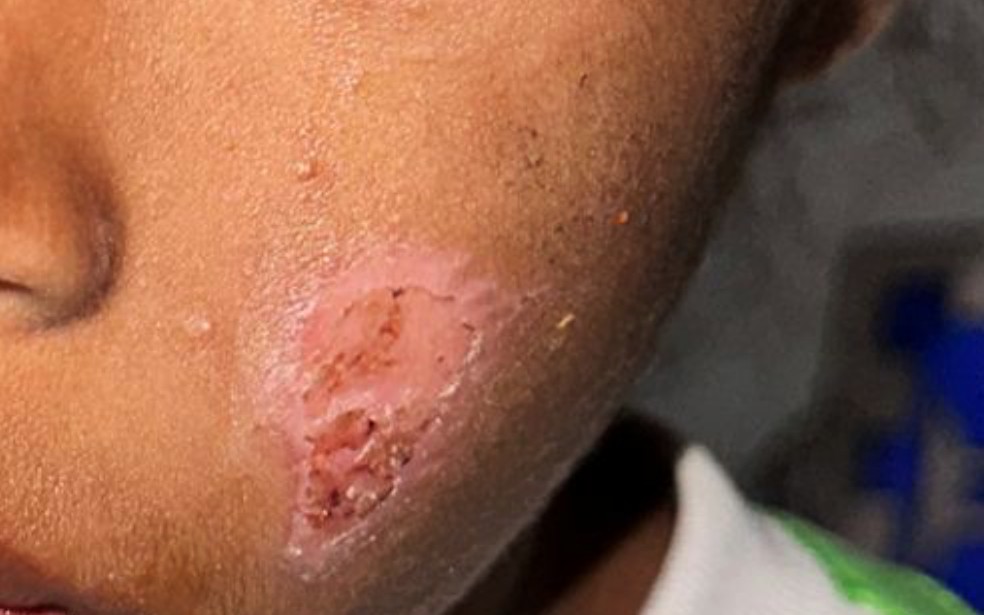 Bochecha de criança ferida após agressão dos pais adotivos no oeste da Bahia — Foto: Redes Sociais