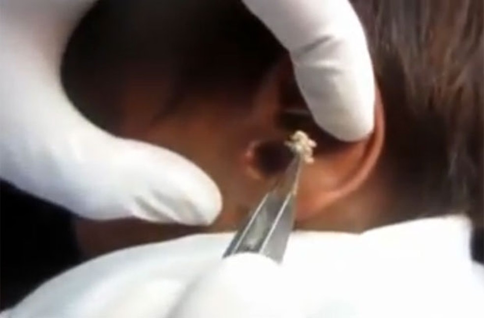 Médico retirou vermes do ouvido de jovem indiano  — Foto: Reprodução/YouTube/ OPRACLEAKsALCAER