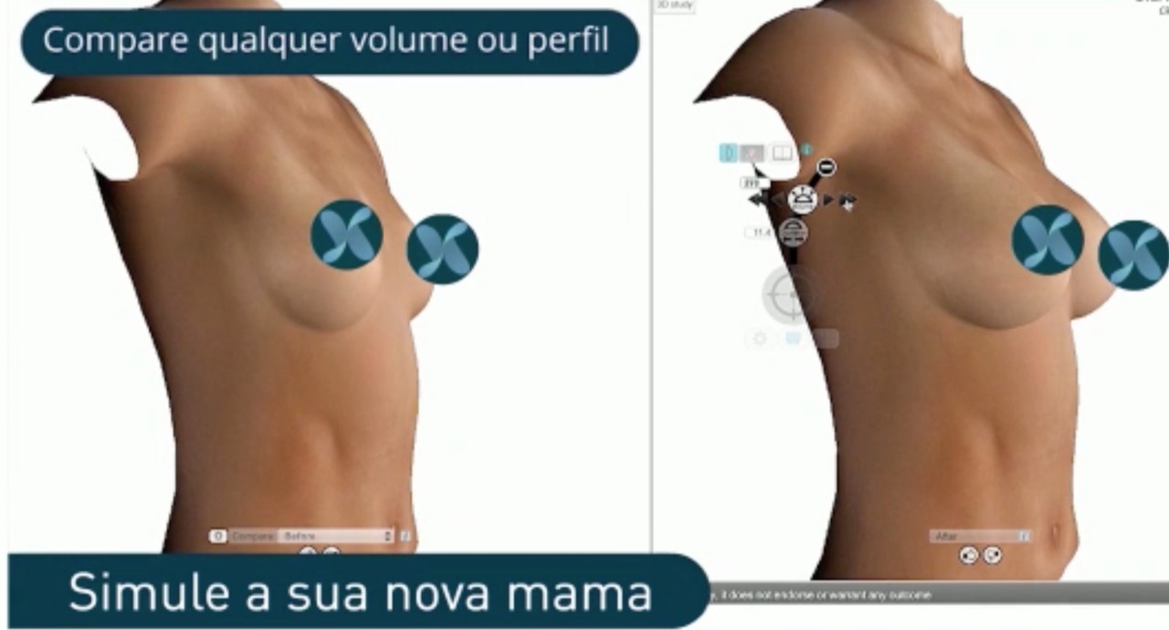 Tecnologia 3D transforma a personalização nas cirurgias plásticas da mama