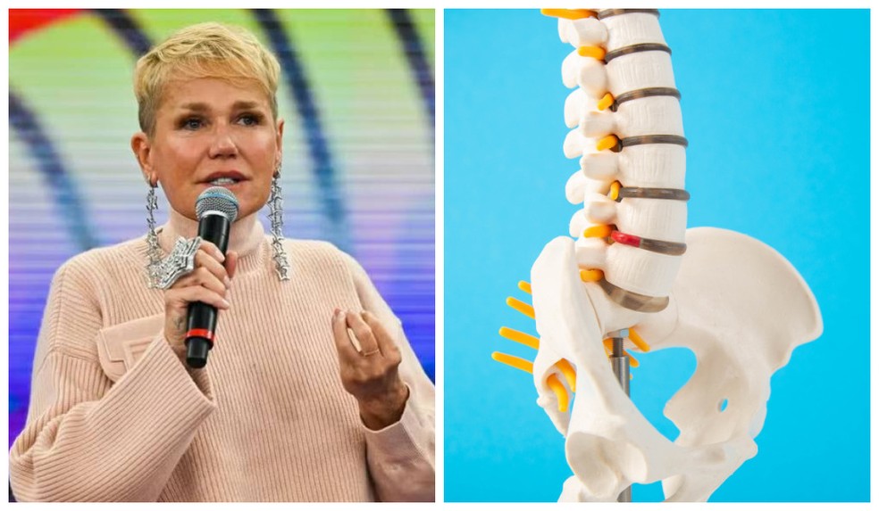Cirurgia da Xuxa na coluna: entenda o que é a estenose de canal e como prevenir — Foto: Bob Paulino/Globo/Abode Stock