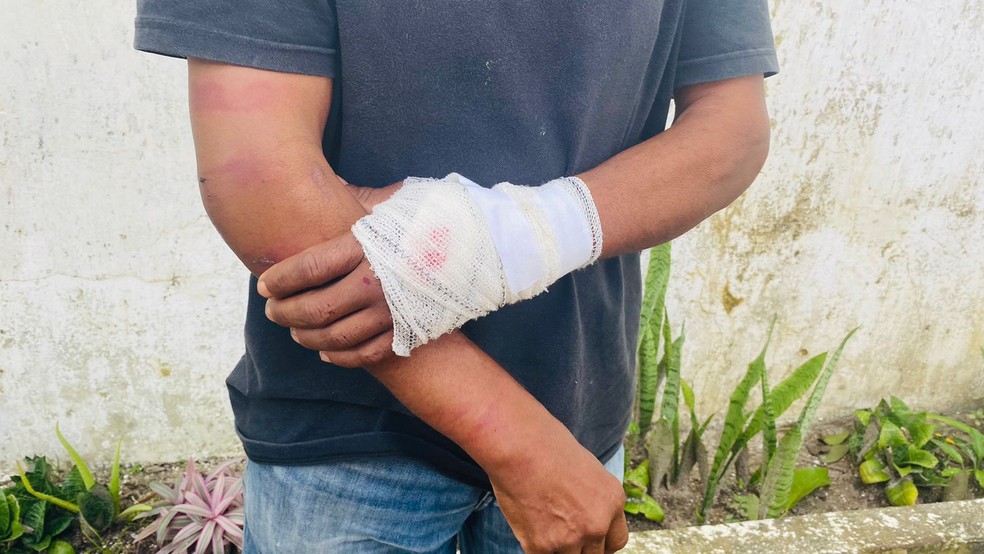 Vítima de tortura com as mãos com curativos em Campina Grande  — Foto: Waléria Assunção / TV Paraíba