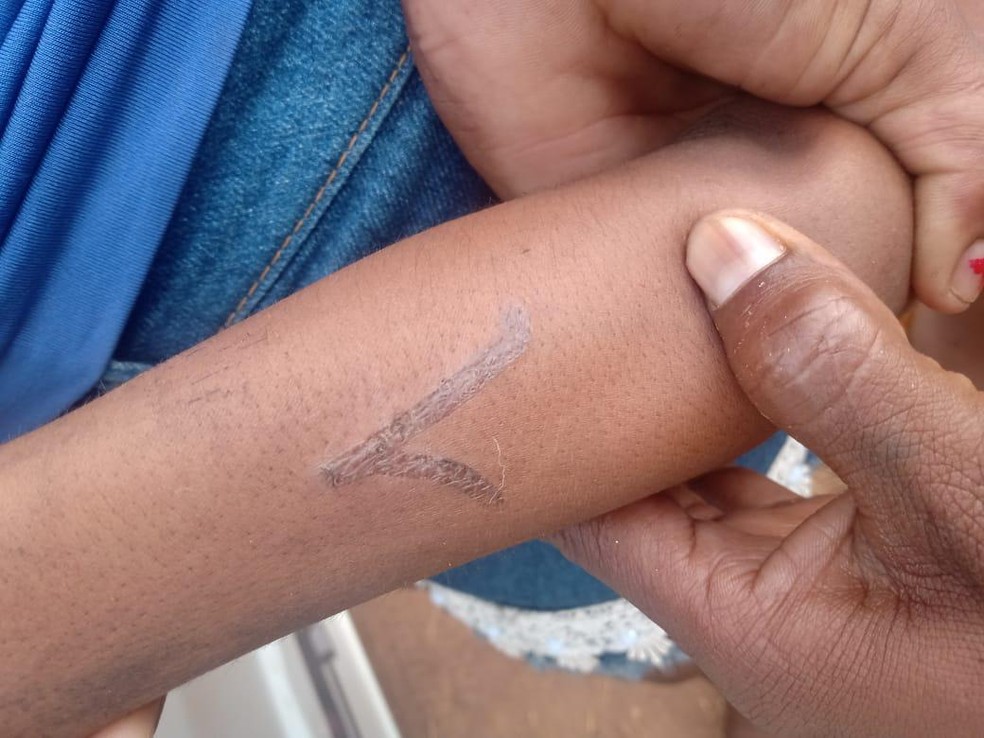 Menino de 6 anos teve o braço ferido — Foto: Divulgação