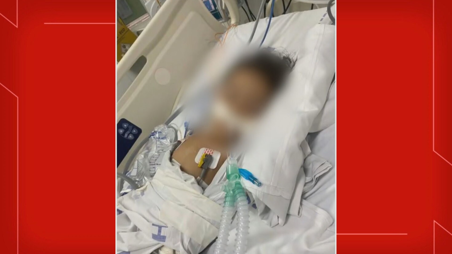 Criança de 1 ano está entubada em UTI após picada de escorpião no DF