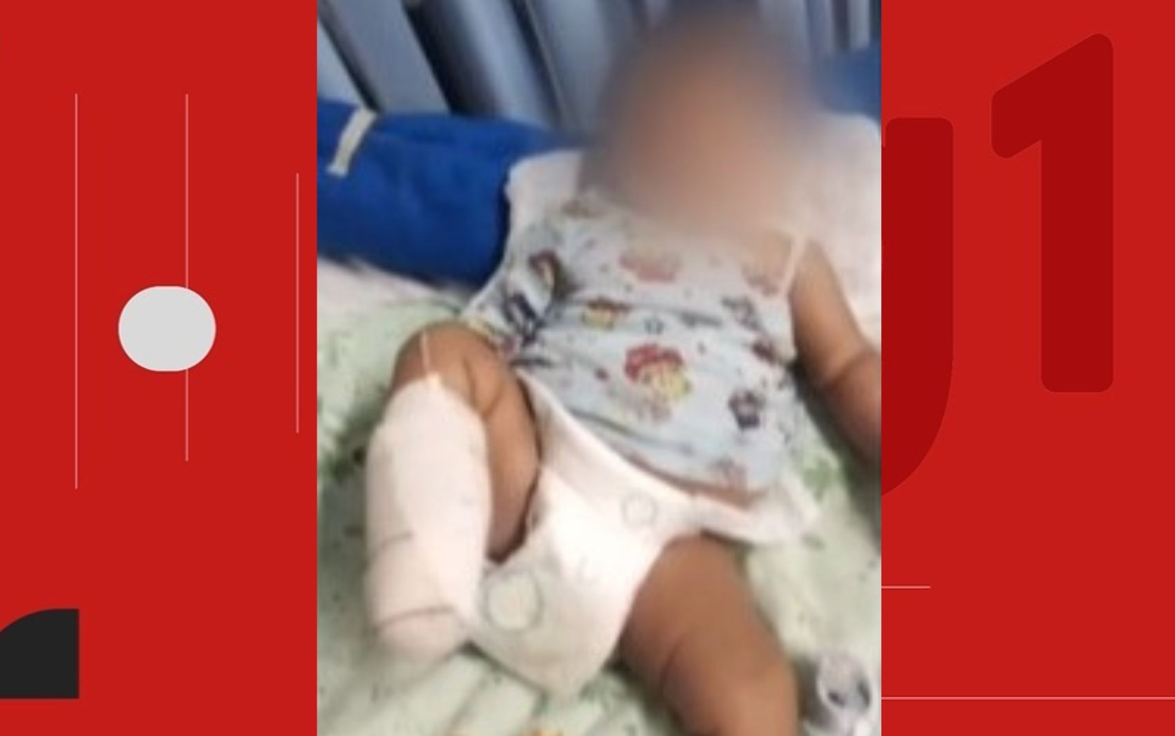 Bebê de 2 meses tem pé amputado após suspeita de infecção e família denuncia negligência de hospital: 'dor muito grande'